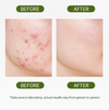 Salicylic Acid Acne Cleanser - Suitable for Both Dry and Oily Skin
